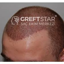 Pin Af Greft Star Pa Sac Ekimi Samsun