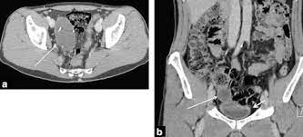 Like many other cancers, when ovarian cancer is found at an early stage (for example, localized to the ovary or fallopian tube) the average survival rate at five years is it is elevated by a large number of disease processes, including but not limited to, diverticulitis, pregnancy, irritable bowel syndrome. Digestive Diseases Mimicking Primary Gynecological Diseases Or With Secondary Gynecological Manifestations Sciencedirect