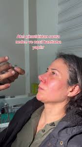 #drbertanbarandemir #piezzoburunestetigi #burunestetiği #nosejobchallenge  #burunameliyatı #rhinoplastiequebec #burunestetiğiöncesisonrası  #rhinoplastieparis #septorhinoplasty #bişektomi ...