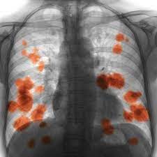 Lung abscess is defined as necrosis of the pulmonary tissue and formation of cavities containing necrotic debris or fluid caused by microbial infection. Lung Cancer Symptoms Even Non Smokers Should Know Signs Of Lung Cancer In Men And Women
