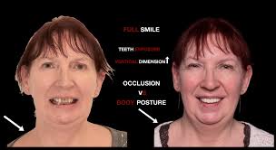 1 year follow up. Treatment of worn dentition of this young girl with  eating desorders. Orthodontics, periosurgery and adhésive dentistry! Thanks  to Gilles Philip! More quality content