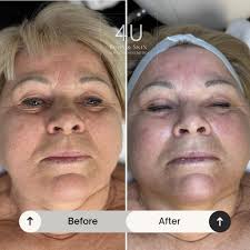 Just After 1st session ❤️ Model 69 years 🥰💪🏽 На фото до/после