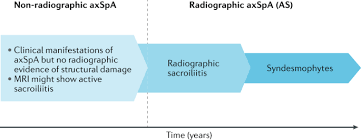 Check spelling or type a new query. Axial Spondyloarthritis Concept Construct Classification And Implications For Therapy Nature Reviews Rheumatology