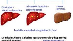 Unele medicamente pe bază de plante sau unele. Steatoza Hepatica Cauze Simptome Cum Se Trateaza 0758751841 Cabinet De Gastroenterologie Si Hepatologie Bucuresti 0758751841 Cabinet De Gastroenterologie Si Hepatologie Bucuresti