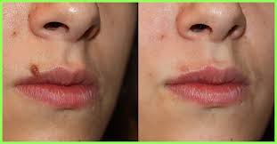 Even if the mole was non cancerous it is still important to keep an eye on any. 10 Best Mole Removal Creams Available In India 2021 Top Picks
