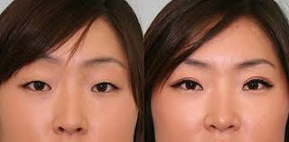 Asian Eyelid Surgery Before After Photos Asian Eyelid Surgery Before After Photos