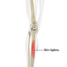 Image result for Shin Splints