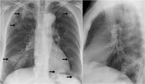 Image result for Air Bronchogram