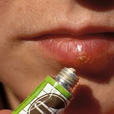 Herpes ist für viele betroffene nicht nur unschön, sondern tut auch sehr weh. Herpes Kann Fur Sauglinge Lebensbedrohlich Werden Der Spiegel