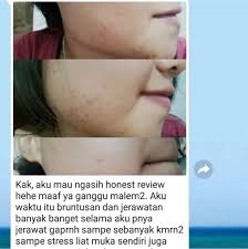 Cuka apel banyak diminati karena berbagai manfaatnya untuk kesehatan dan juga kecantikan. Apple Vinegar Toner Pinkies Beauty Shopee Indonesia