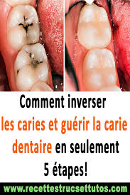 Comment Inverser Les Caries Et Guerir La Carie Dentaire En Seulement 5 Etapes Santebienetre Remedesnaturels Conseilsante Teeth Food