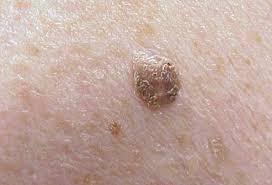 (2) it affects the epidermal keratinocyte cells of the skin. Picture Of Skin Diseases And Problems Seborrheic Keratosis