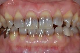 Image result for Tooth Discoloration