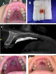 Common sources of infections are from soil, damp walls on old buildings etc. Painful Palatal Lesion In A Patient With Covid 19 Oral Surgery Oral Medicine Oral Pathology And Oral Radiology