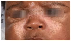Lupus néonatal se manifestant comme une éruption cutanée en forme de papillon | CMAJ
