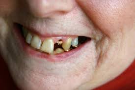 How long does it take to get a root canal. What Are The Consequences Of Delaying A Root Canal Howstuffworks