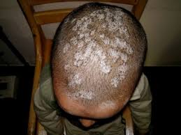 Scalp involvement is typically seen as a localized patch of white or grey hair but total loss of color. Get Ride Of A Child Head White Patches