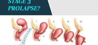 Image result for Rectal prolapse