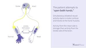 new post stroke electrical stimulation therapy