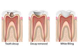 A larger filling or multiple fillings can take longer. Dental Fillings For Children Adults 1st Family Dental