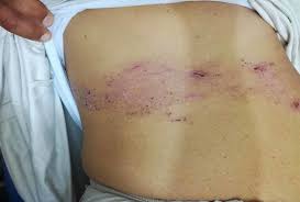 Herpes simplex virus (hsv) infection in newborns. Cureus Herpes Zoster Infection As A Presentation For Hidden Diabetes Mellitus