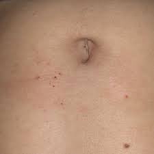 Pickel Um Den Bauchnabel Was Tun Gesundheit Und Medizin Tattoo Ausschlag