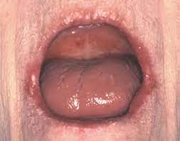 Một số người chỉ gặp vài triệu chứng nhẹ, một số không hề có. Kho Miá»‡ng Va Nhá»¯ng Bá»‡nh Lien Quan