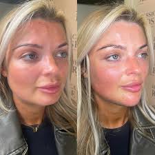 LIPS & CHIN ✨ By Bethany. Want these kind of natural tweaks? We're the  injectors for you🙋🏻‍♀️ We specialise in facial harmony, so if that's what  you're after, natural tweaks… we got