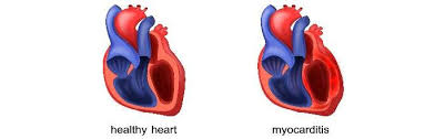 Given that myocarditis often leads to hospitalization, this task seems easy to carry out in hospital practice; Cos E La Miocardite E Come Si Manifesta