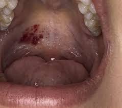 Image result for Mouth ulcers symptoms roof of the mouth