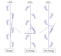 Image result for Foot Progression Angle
