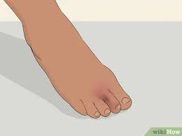She can rule out a more serious injury such as a fracture. How To Buddy Tape An Injured Toe 7 Steps With Pictures