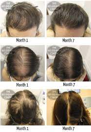 The loss is diffuse and involves the entire scalp rather than discrete areas. Pin On Hair Loss Treatment