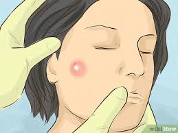 But there are cases of mucous cysts that get bigger and take on odd shapes. How To Remove A Cyst On Your Face 9 Steps With Pictures