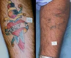 Depending on the location of your tattoo, you may want to apply a topical anesthesia cream beforehand. 9 Best Laser Tattoo Removal Treatments Styles At Life