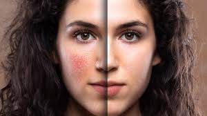 Image result for ekzema face