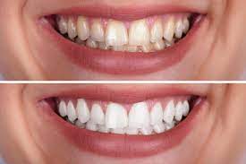 Check spelling or type a new query. Diy Tooth Whitening Vs Professional Teeth Whitening Bonham Dental