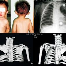 They articulate with the vertebral column posteriorly, and terminate they also have a role in ventilation; Fig A B The Little Girl S Portraits In Front And In Back Showing Download Scientific Diagram