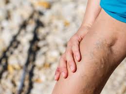 People suffering from spider veins on the face have to experience not only physically but mentally as well. 10 Things You Didn T Know About Varicose Veins