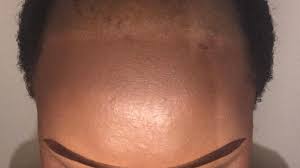 Tenderness is a sign that there is inflammation and possible infection. African Women On The Shame Of Hair Loss Bbc News
