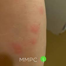 Image result for bedbug bites look like