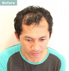 前編 男の薄毛を自然に隠せる髪型22選 o字m字などハゲを熟知した美容師のヘアカタログ aga対応髪型 23番目の画像 薄毛 髪型 薄毛ヘアスタイル
