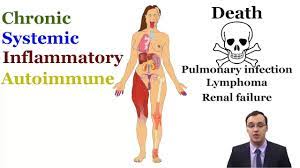 Sjogren S Syndrome Youtube