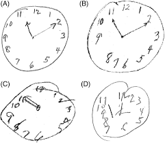 9 montreal cognitive assessment (moca) takes. Jags On Twitter Optimizing Clock Drawing Scoring Criteria Development Of The West Haven Yale Clock Drawing Test Geriatrics Https T Co Fuhx4cdqca Https T Co 4a37tzjezm