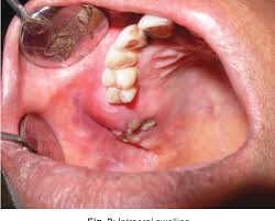 4.9k views reviewed >2 years ago. Pdf Osteosarcoma Of Maxilla Semantic Scholar