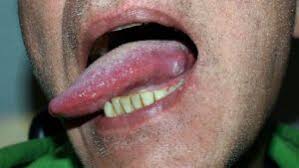 Image result for cancer of tongue