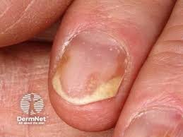 Image result for Onycholysis feet