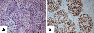 Kurang dari 5 % kanker endometrium adalah tipe clear cell carcinoma. Moderately Differentiated Adenocarcinoma Intestinal Type Consisting Download Scientific Diagram