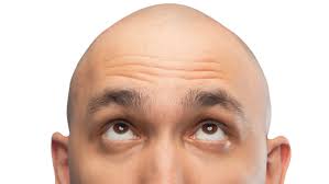 Balding can be tough for men, especially when people point it out. Here's  how our readers deal with it - ABC News