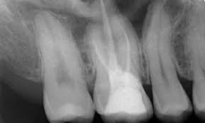 During a root canal procedure, the nerve and pulp of the tooth are removed and the inside is cleaned and sealed. Failure Of Root Canal Treatment Misdiagnosed As Neuropathic Pain Case Report Jcda